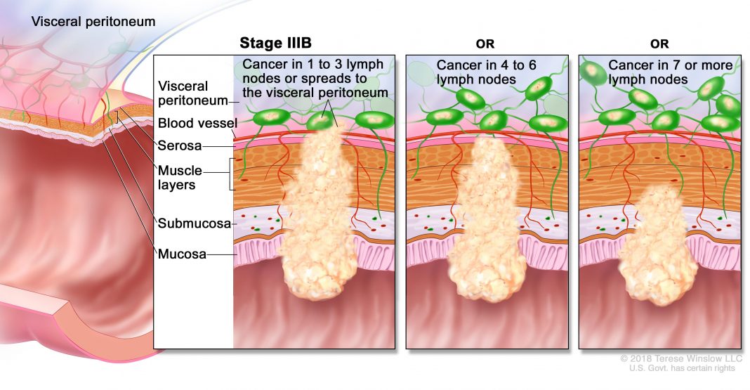 Colon Cancer প্রতিকার এর চেয়ে প্রতিরোধ শ্রেয়
