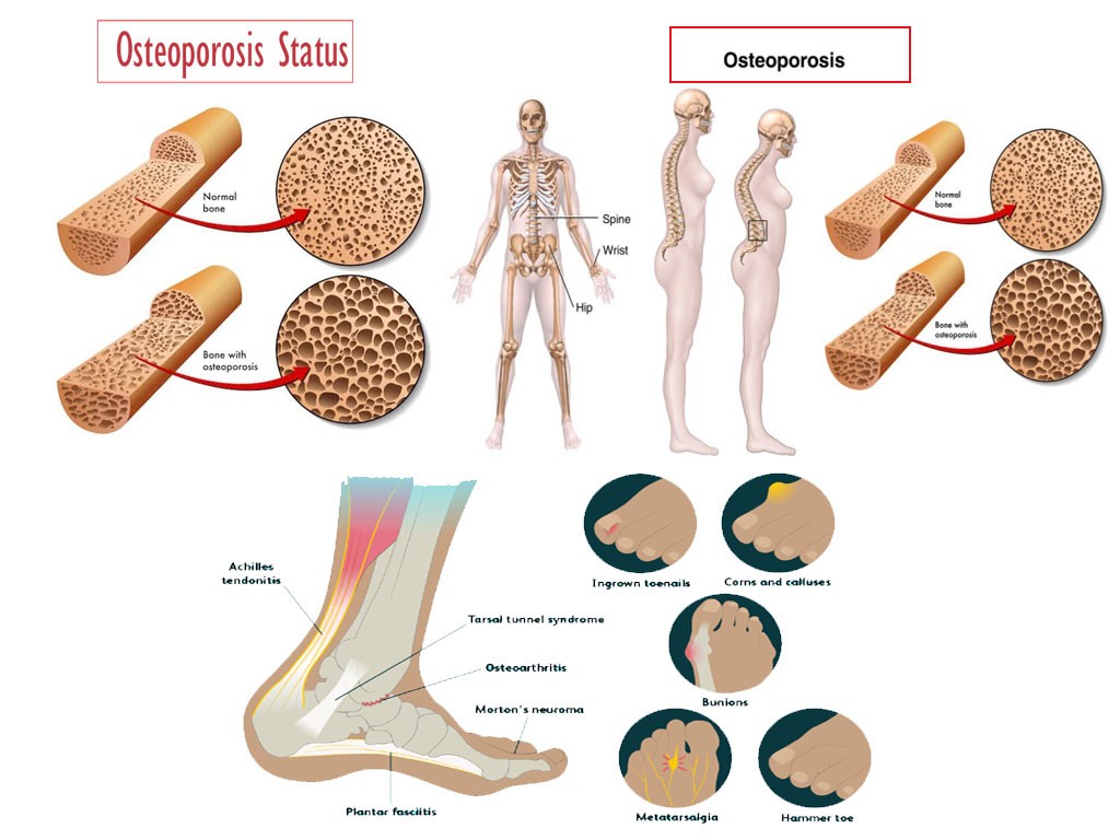 Osteoporosis, Arthritis & bone fractures