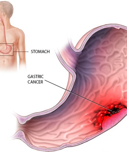 Stomach-Cancer-–-Causes-Symptoms-Diagnosis-And-Treatment